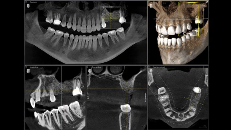 Orthophos SL Dentist Detects Sleep Apnea