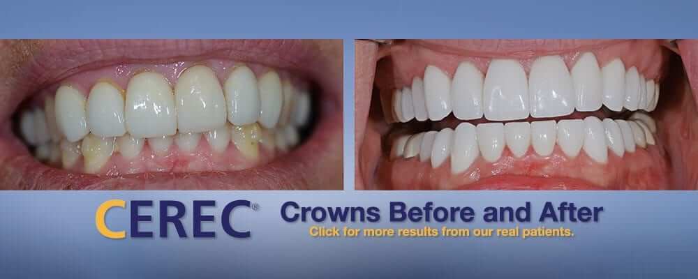 CEREC Crowns and Veneers Full Smile Patient Makeover