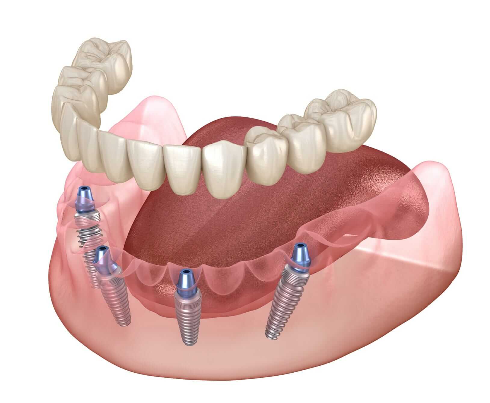 all on four dental implants cost