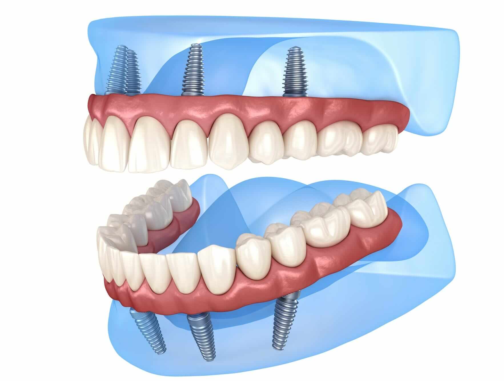 All on Four Dental Implant Dentist at Lakefront Family Dentistry in Lake Elsinore.