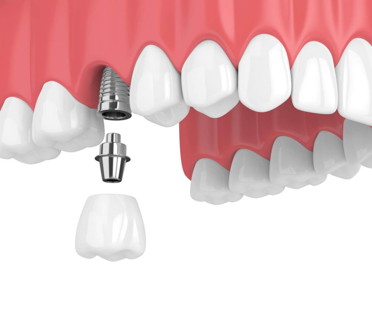 Nobel Biocare Dental Implants at Lakefront Family Dentistry.
