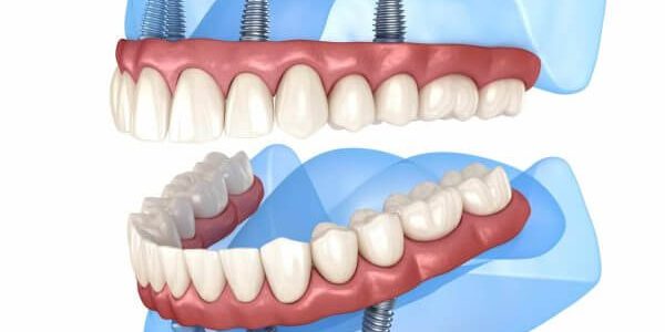 All on 4 Dental Implants