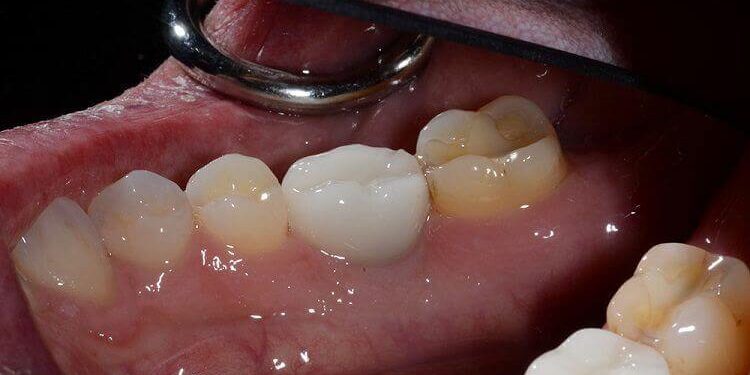 Two Crowns Over Dental Implants