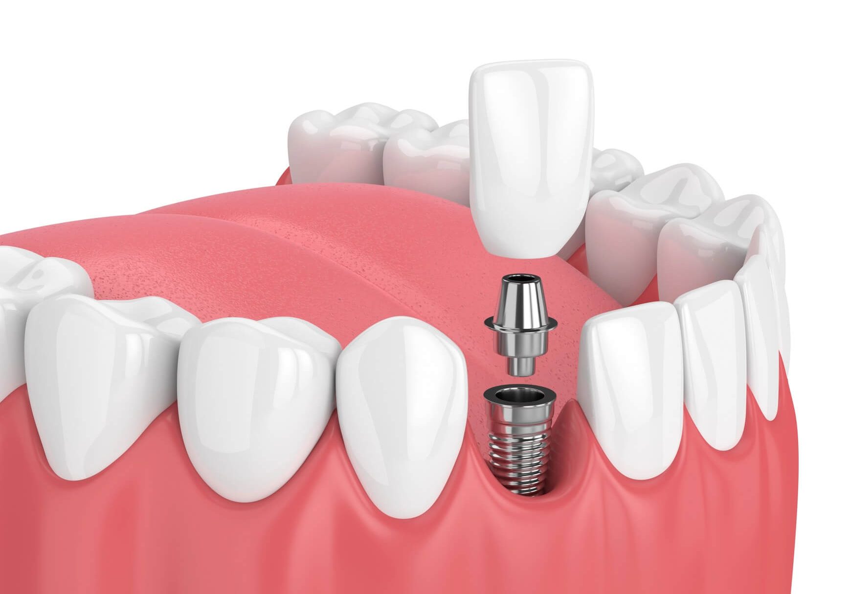 dental implant choice