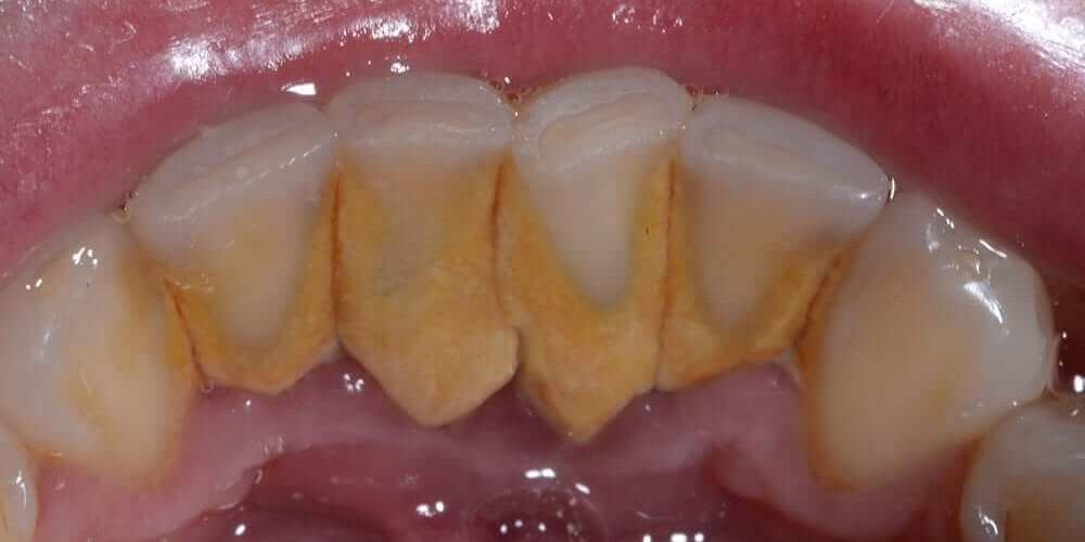 https://lakefrontfamilydentistry.com/images/bb-plugin/cache/peridontal-disease-treatment-and-deep-teeth-cleaning-required-for-hard-plaque-build-up-panorama-a0151ae74963e7bf0f80e8f5ca499dca-ficev6xsgowz.jpg