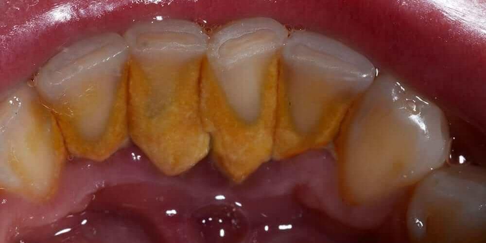Severe Plaque Build Up with Severely Worn Detention from Bruxism