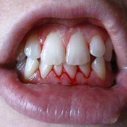 Swollen Gums and How to Stop Bleeding Gums