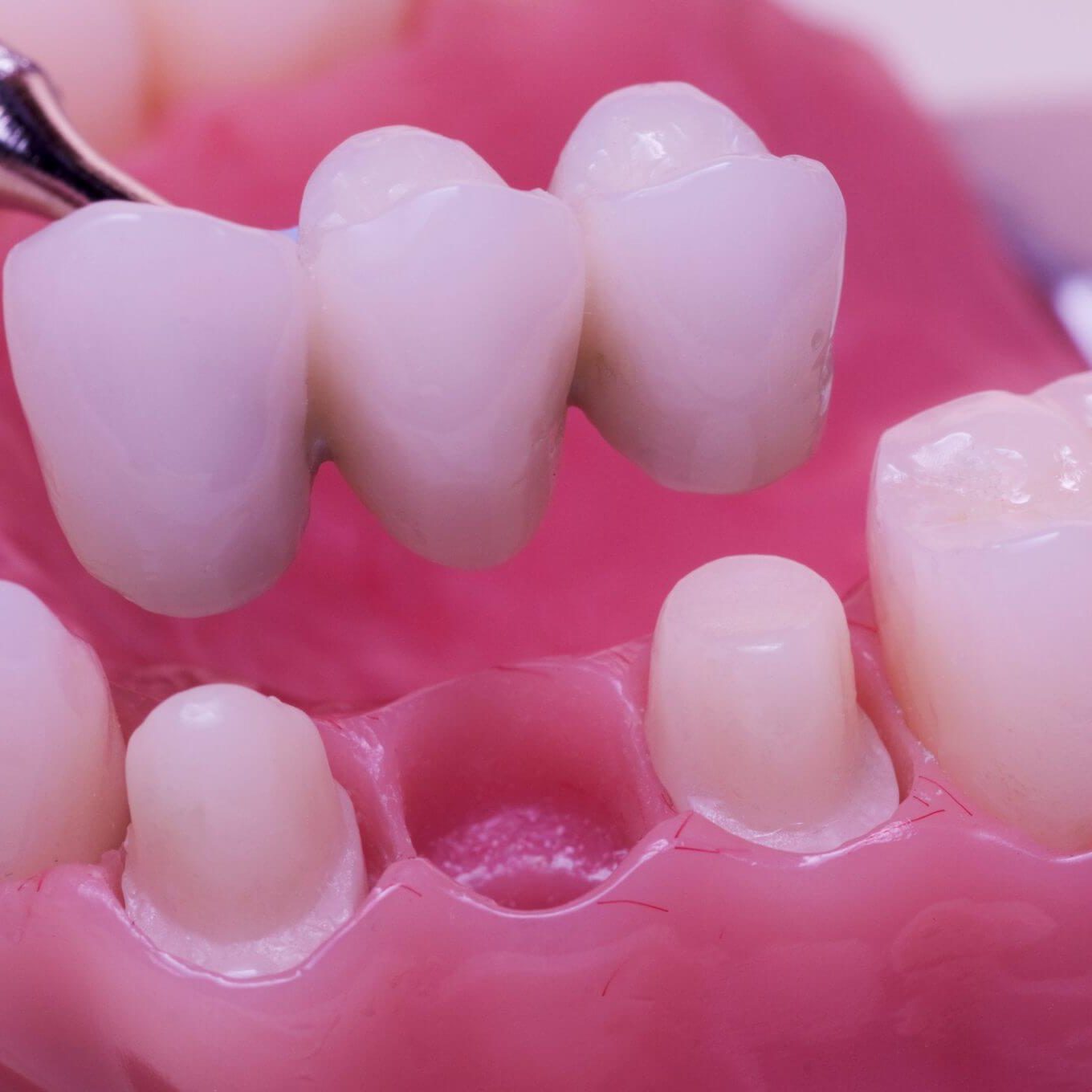 custom dental bridge