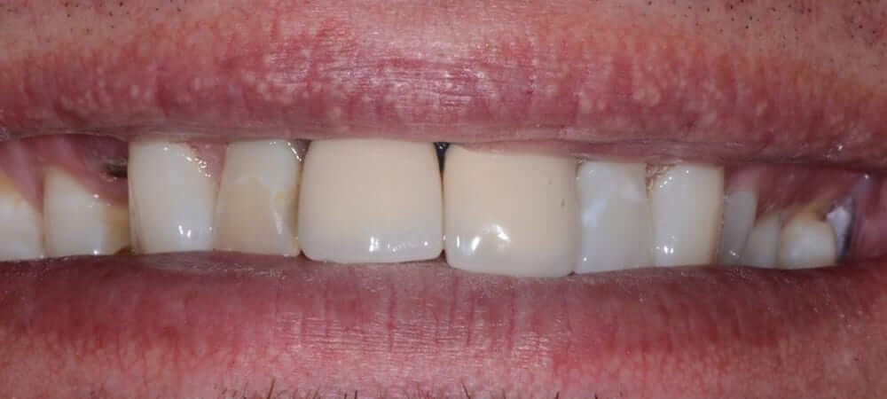 before new veneers and crowns patient photo