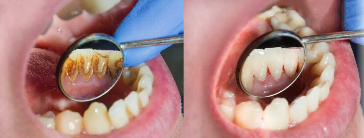 before and after periodontal disease plaque tartar removal