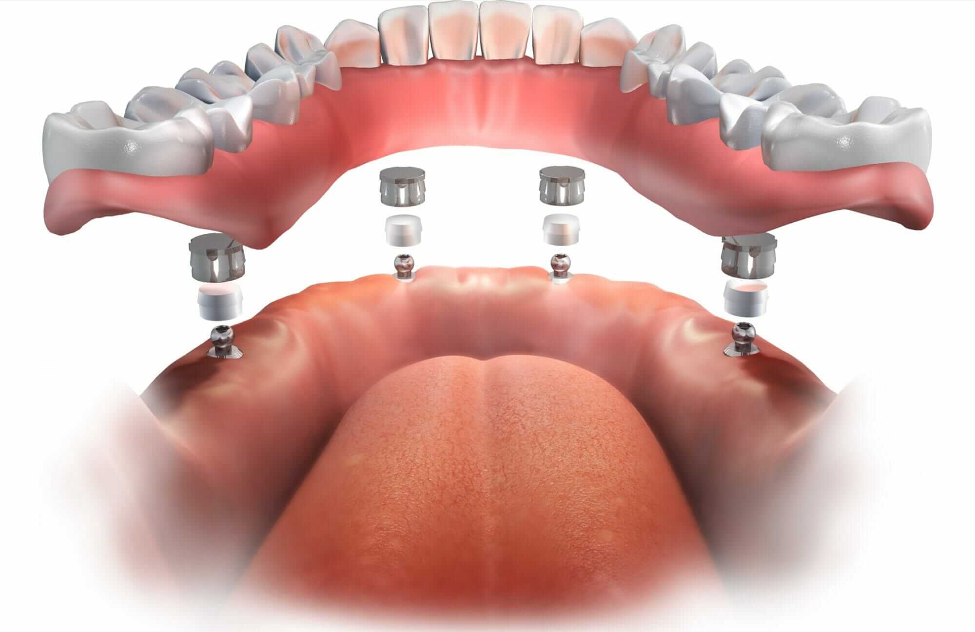 The best dentist for bridge with dental implants is Lakefront Family Dentistry in Lake Elsinore, California.