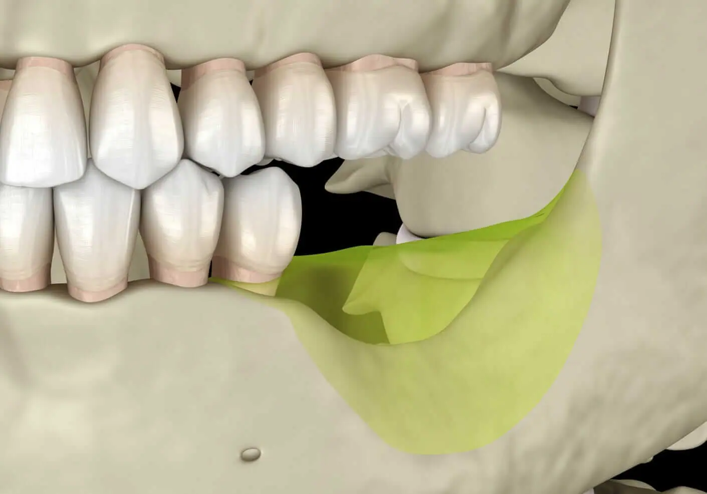 Jaw and Gum Resorption, Brush & Floss Dental Center