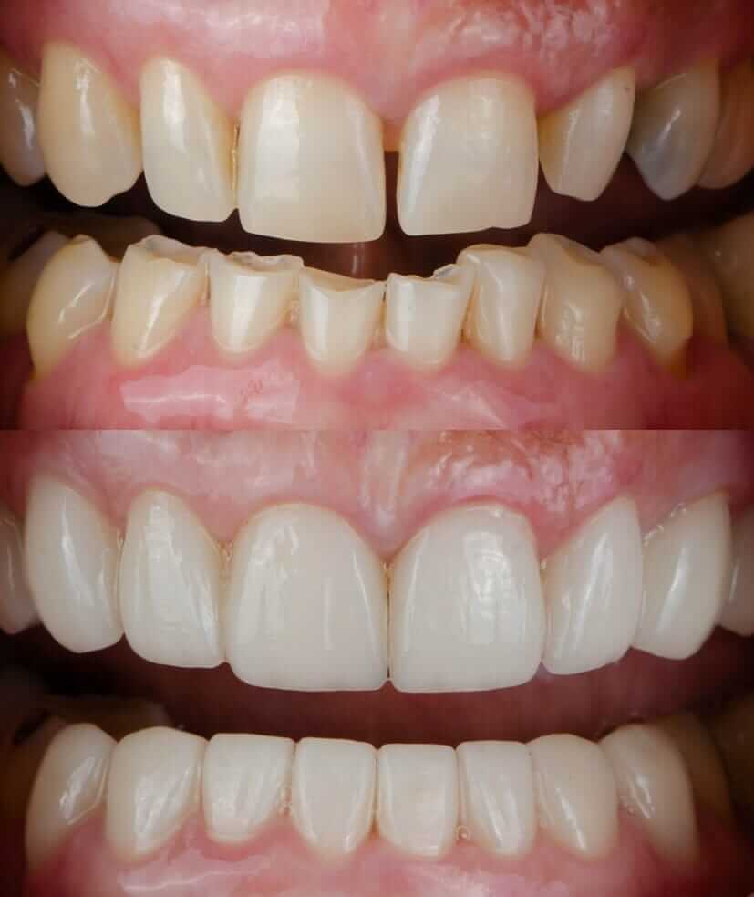 bruxism before and after treatment with porcelain veneers using CEREC in our office