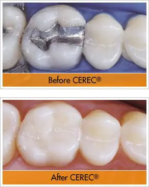 Dr. Hauser Can Fix Broken Tooth - Chipped Tooth Repair