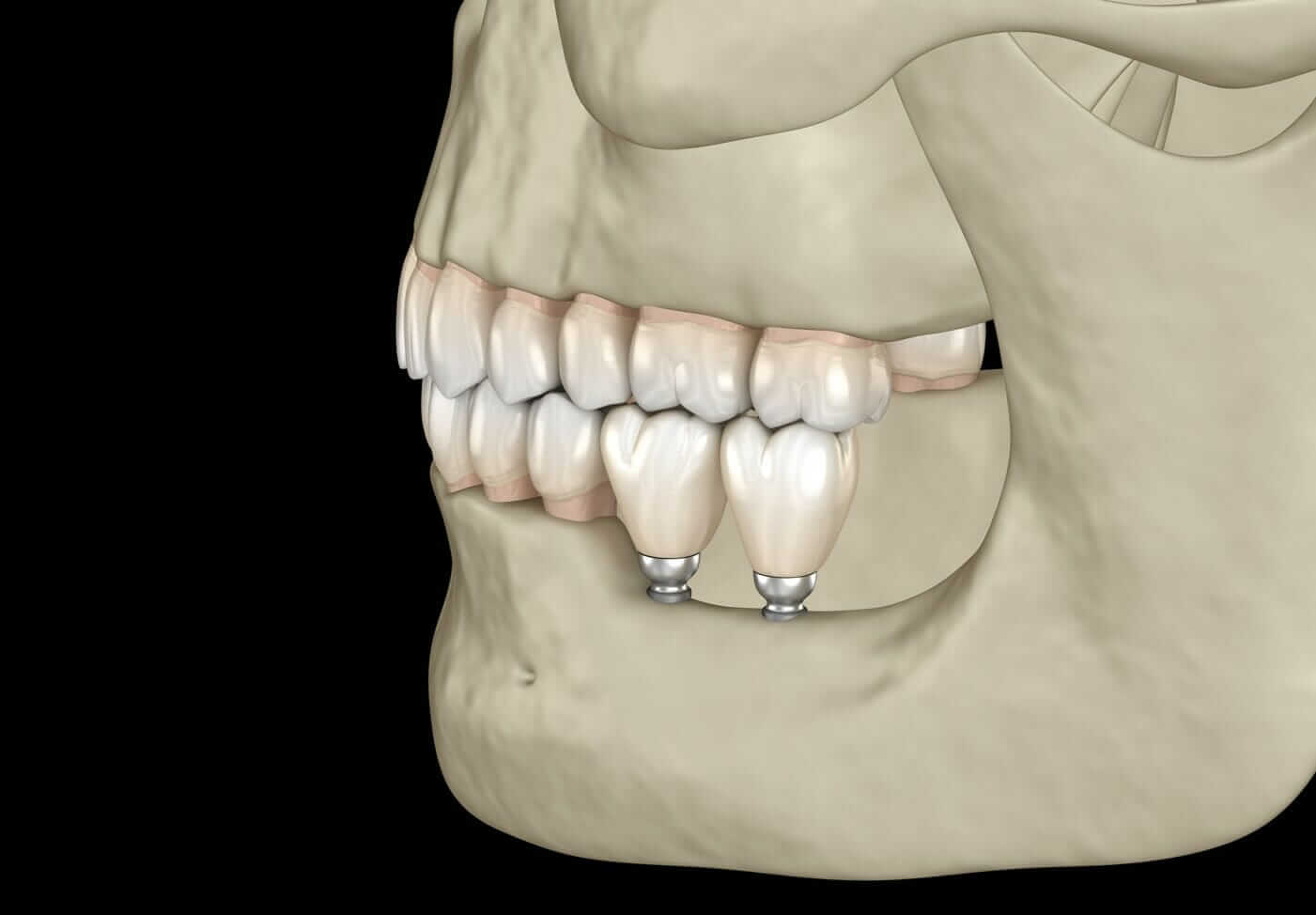 Dental Implants Due to Jaw Bone Resorption