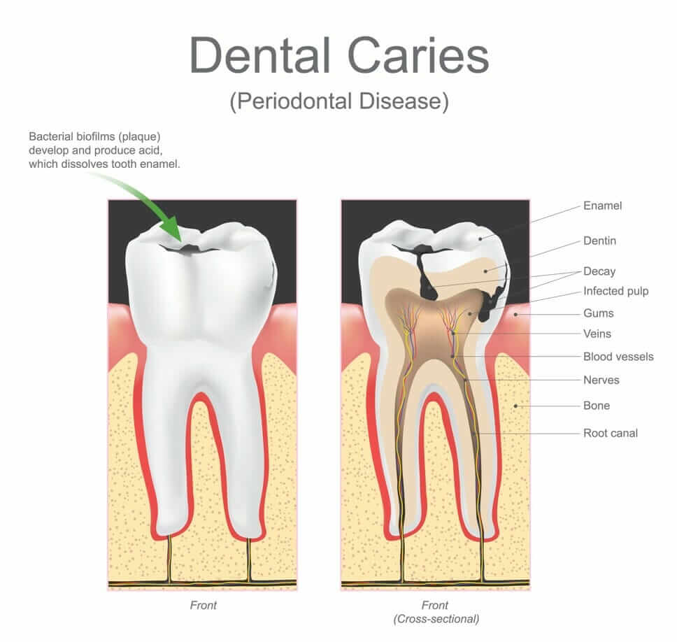 dental caries