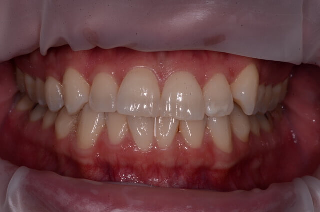 Dental Enamel Hypoplasia