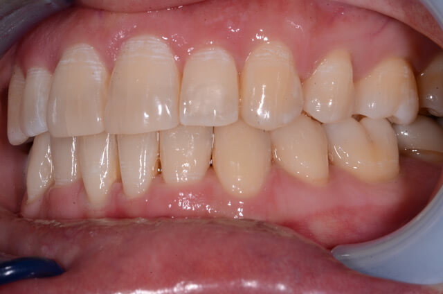 Dental Enamel Hypoplasia - Patient Image Copyright by Lakefront Family Dentistry