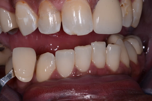 dental enamel hypoplasia and teeth decay with cavities