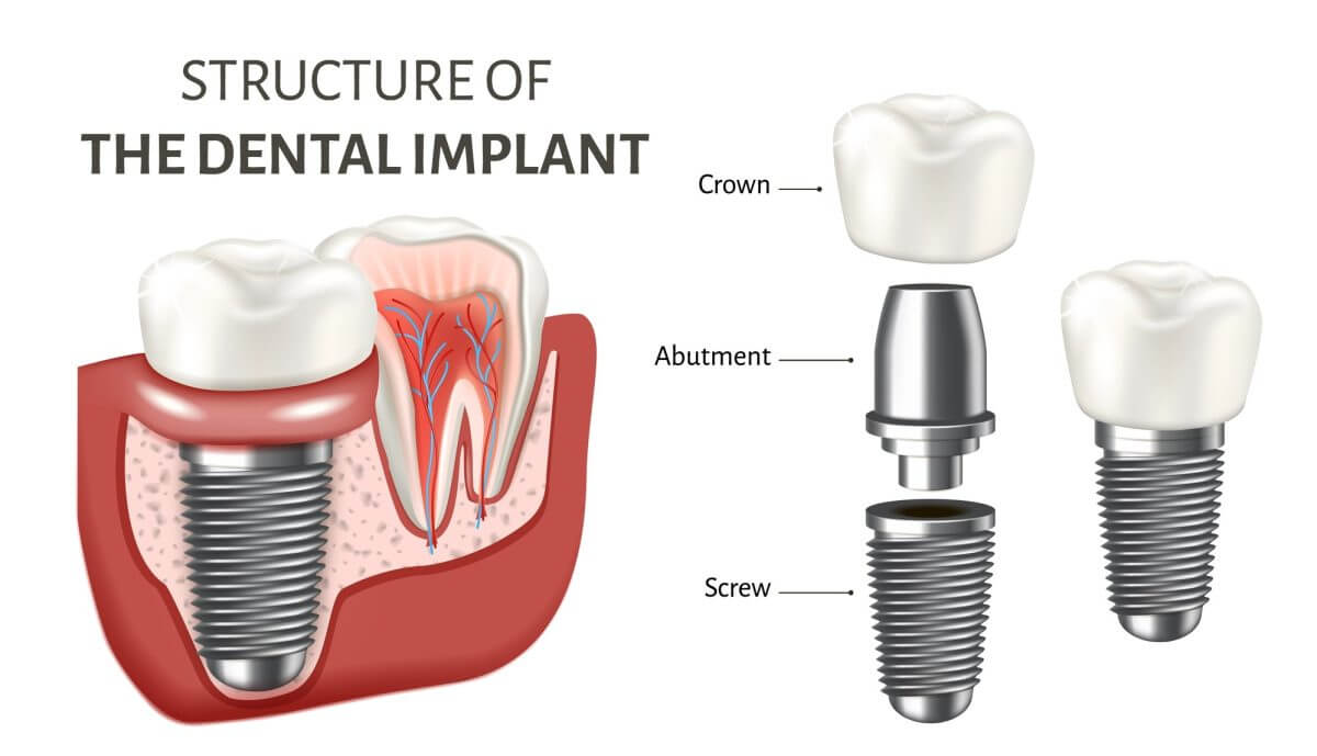 missing tooth replacement with nobel biocare dental implants