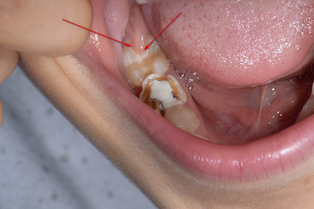 This extra skin covering the tooth is called as a dental operculum, also known as a pericoronal flap.