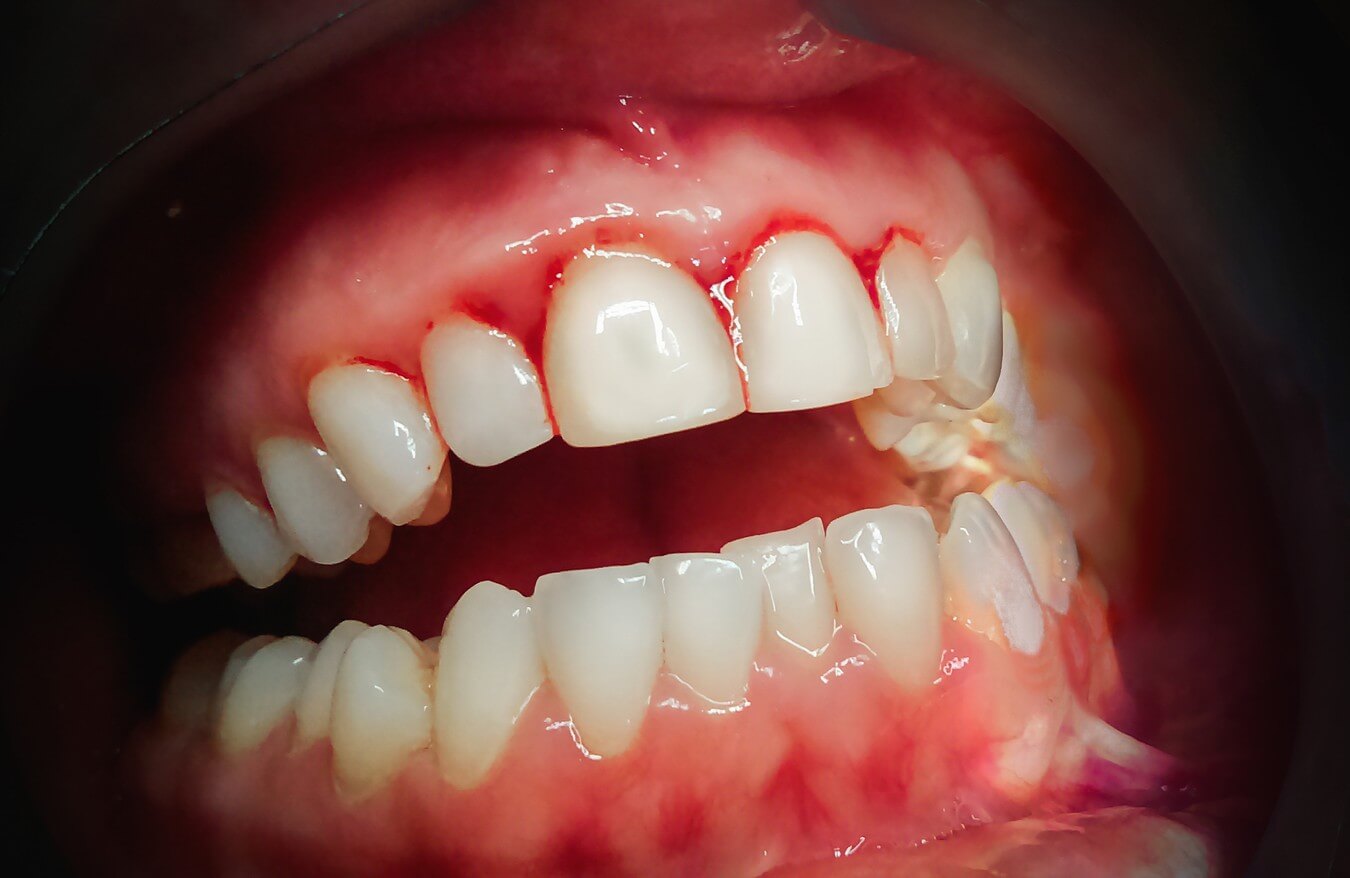 Visible Gum Disease Symptoms Requiring Treatment. ANUG is a serious dental condition and needs treatment right away.