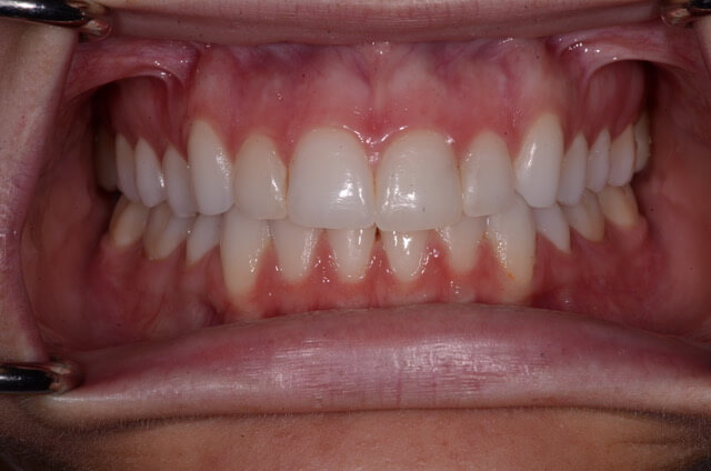 Dental Enamel Hypoplasia - Enamel Erosion