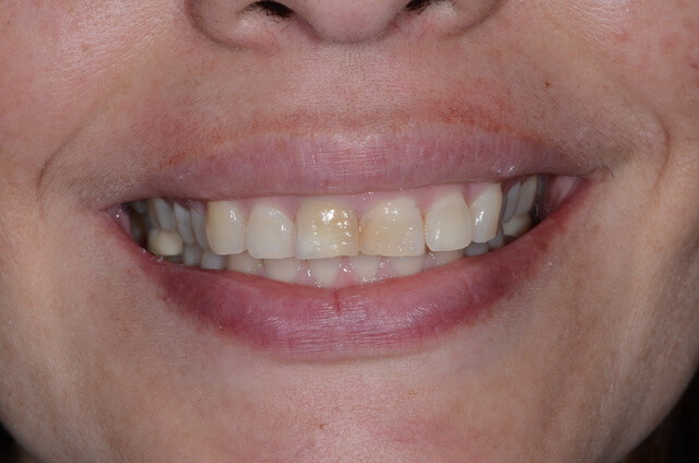 Dental Enamel Hypoplasia - Patient Image Copyright by Lakefront Family Dentistry