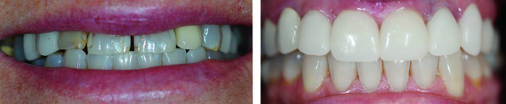 Professional Teeth Whitening and Five Porcelain Crowns in Front