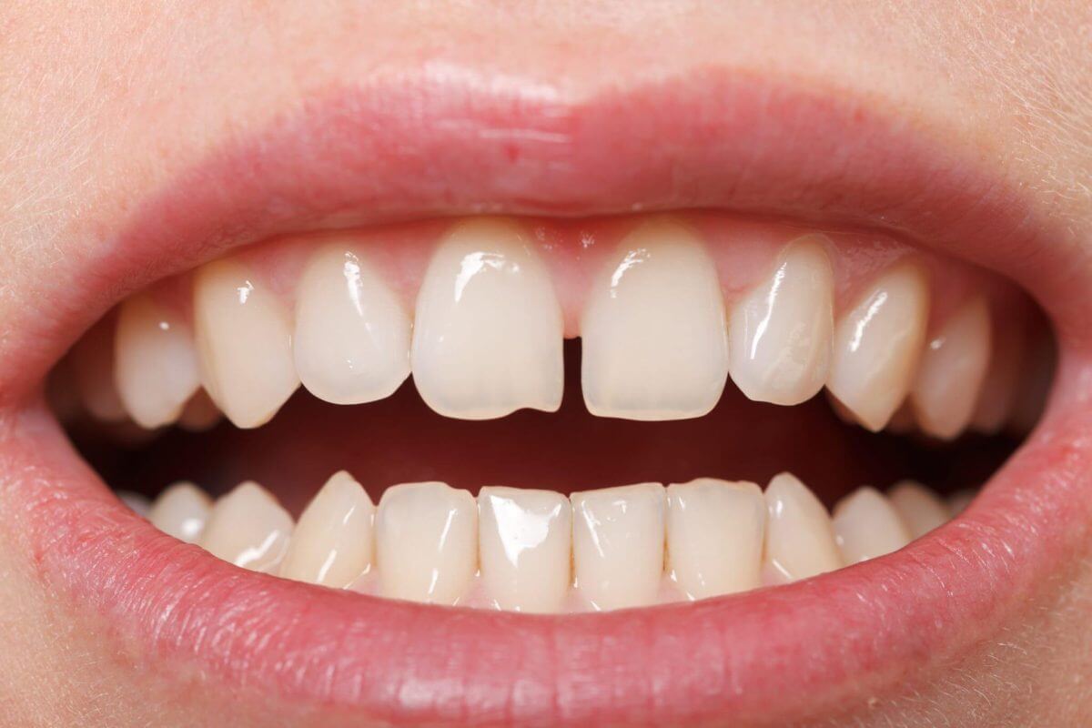 Diastema - Tooth Gap