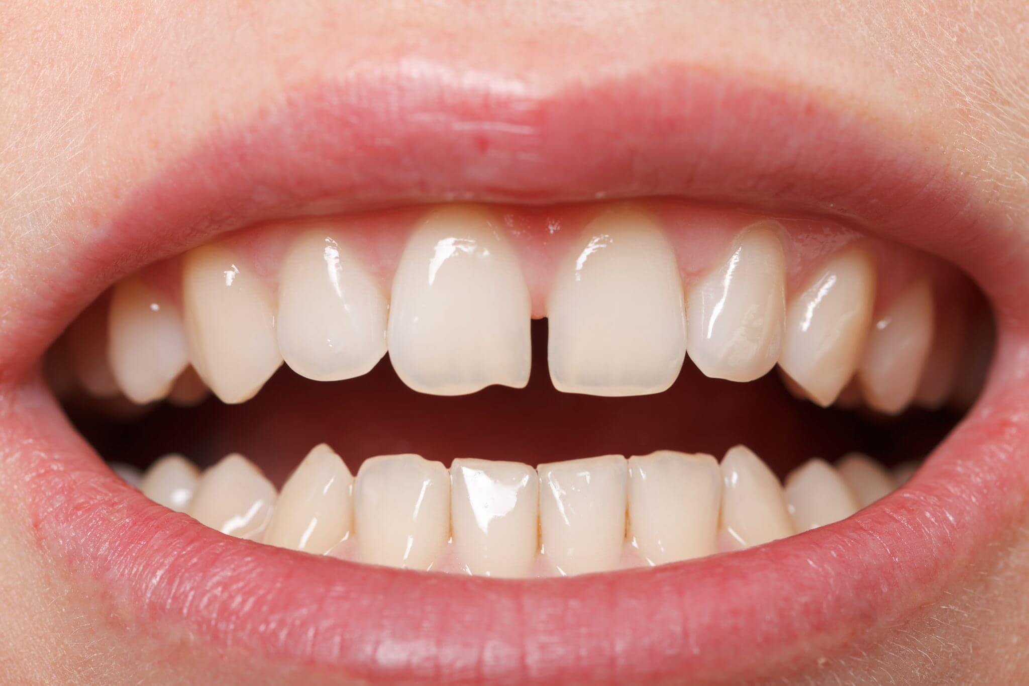 Struggling with Fixing Your Front Teeth Gap?