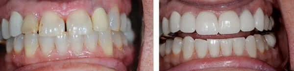 Full Mouth Teeth Whitening to Match New CEREC Crowns