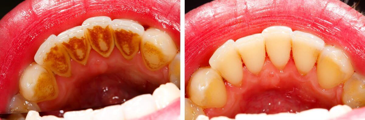 Gum Infection and Periodontitis Treatment with Professional Teeth Cleaning