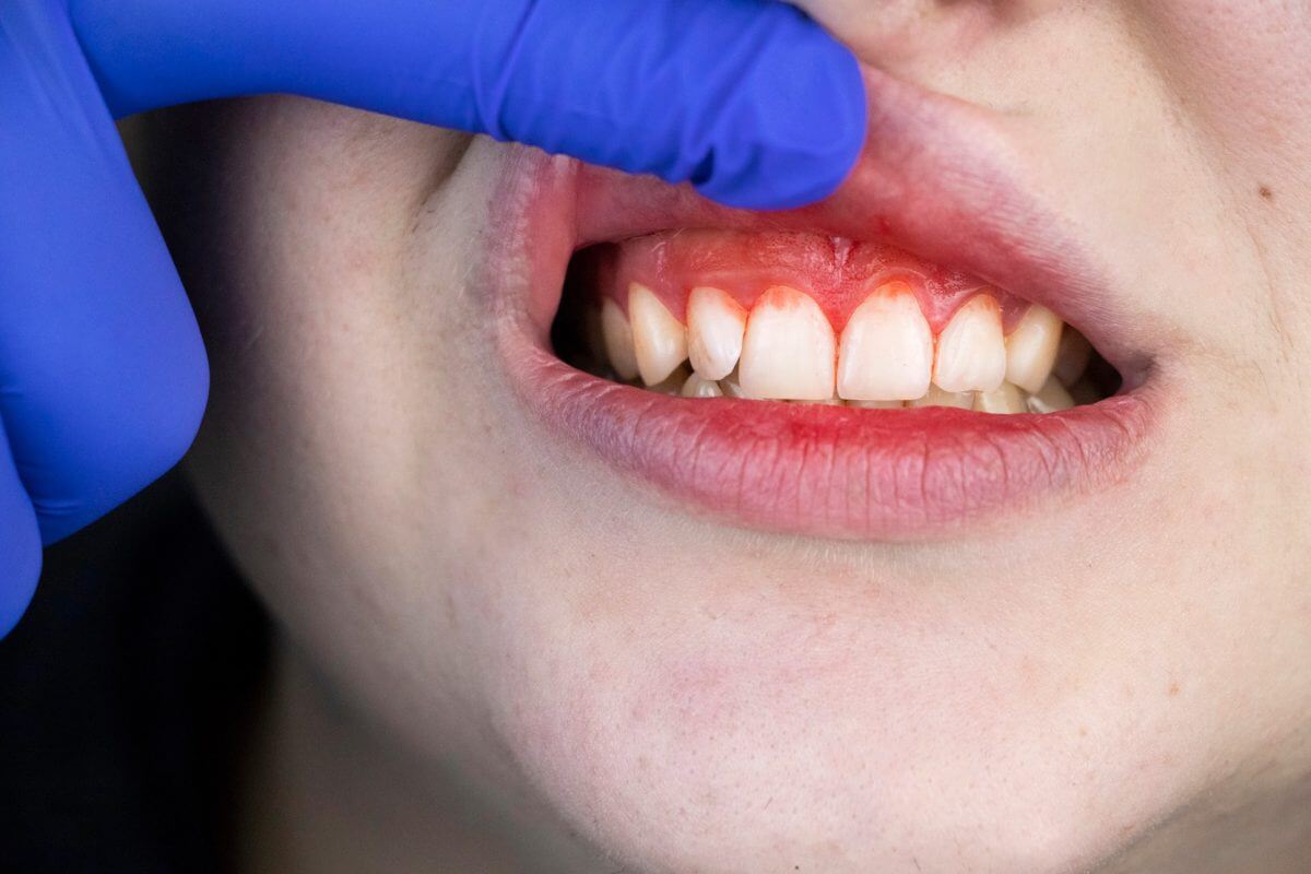 gum swelling and bleeding