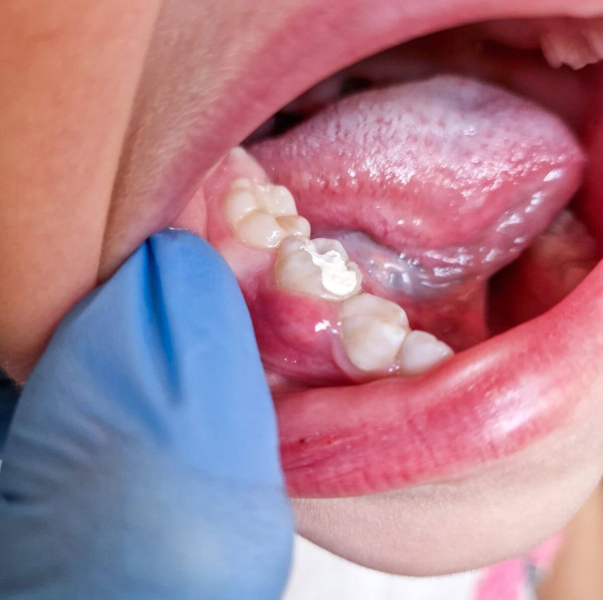 gum swelling under tooth