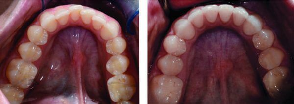 invisalign before and after bottom teeth crooked and corrected