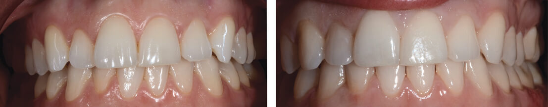 invisalign before and after front crooked teeth and spacing