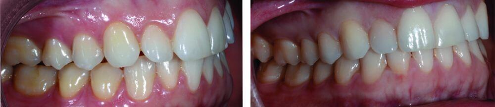 Crooked Teeth and Spaced Far Apart - Before and After Invisalign Treatment