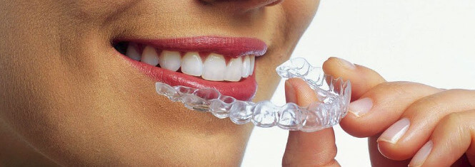 Invisalign Clear Aligners