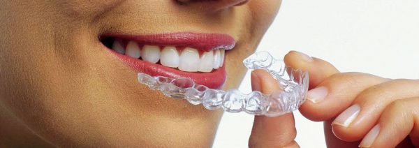 Invisalign Clear Aligners Corrects Malocclusion