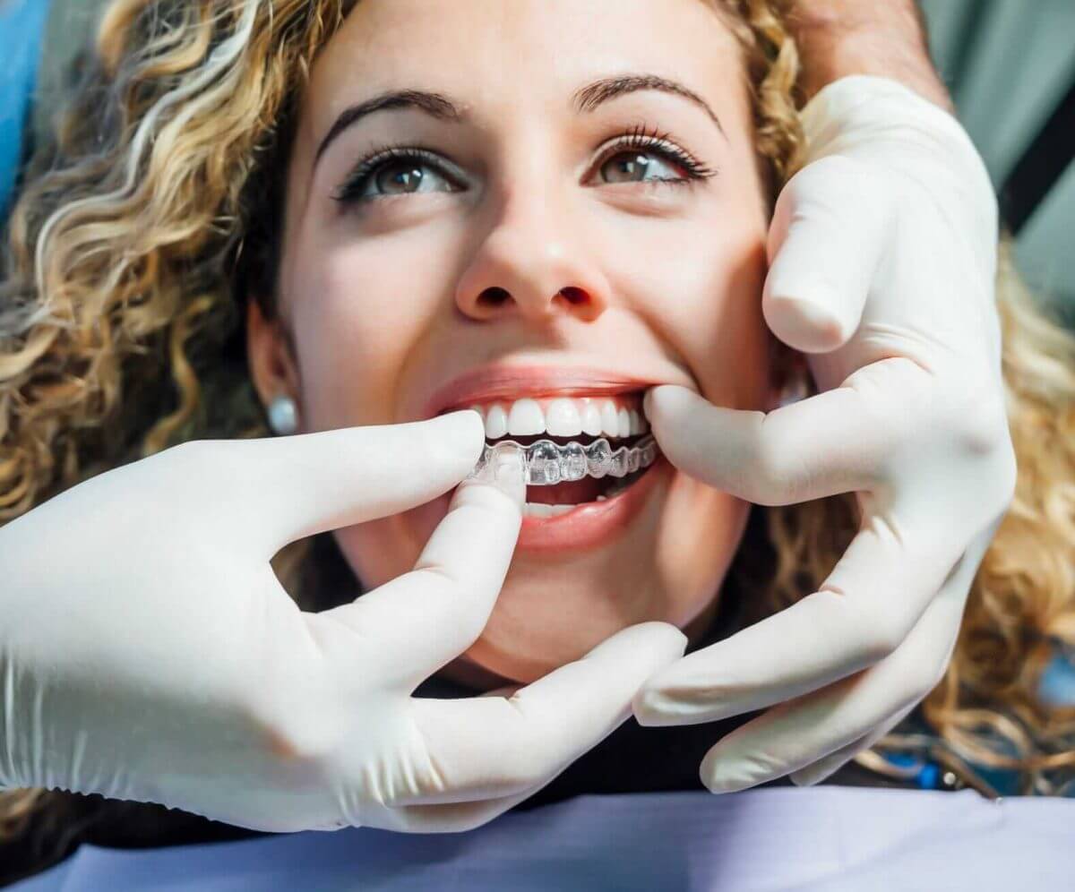 Invisalign Underbite Correction for Adults
