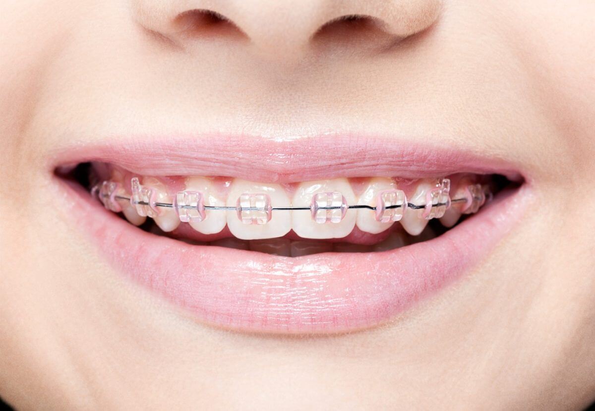 Self-Ligating Braces vs. Invisalign