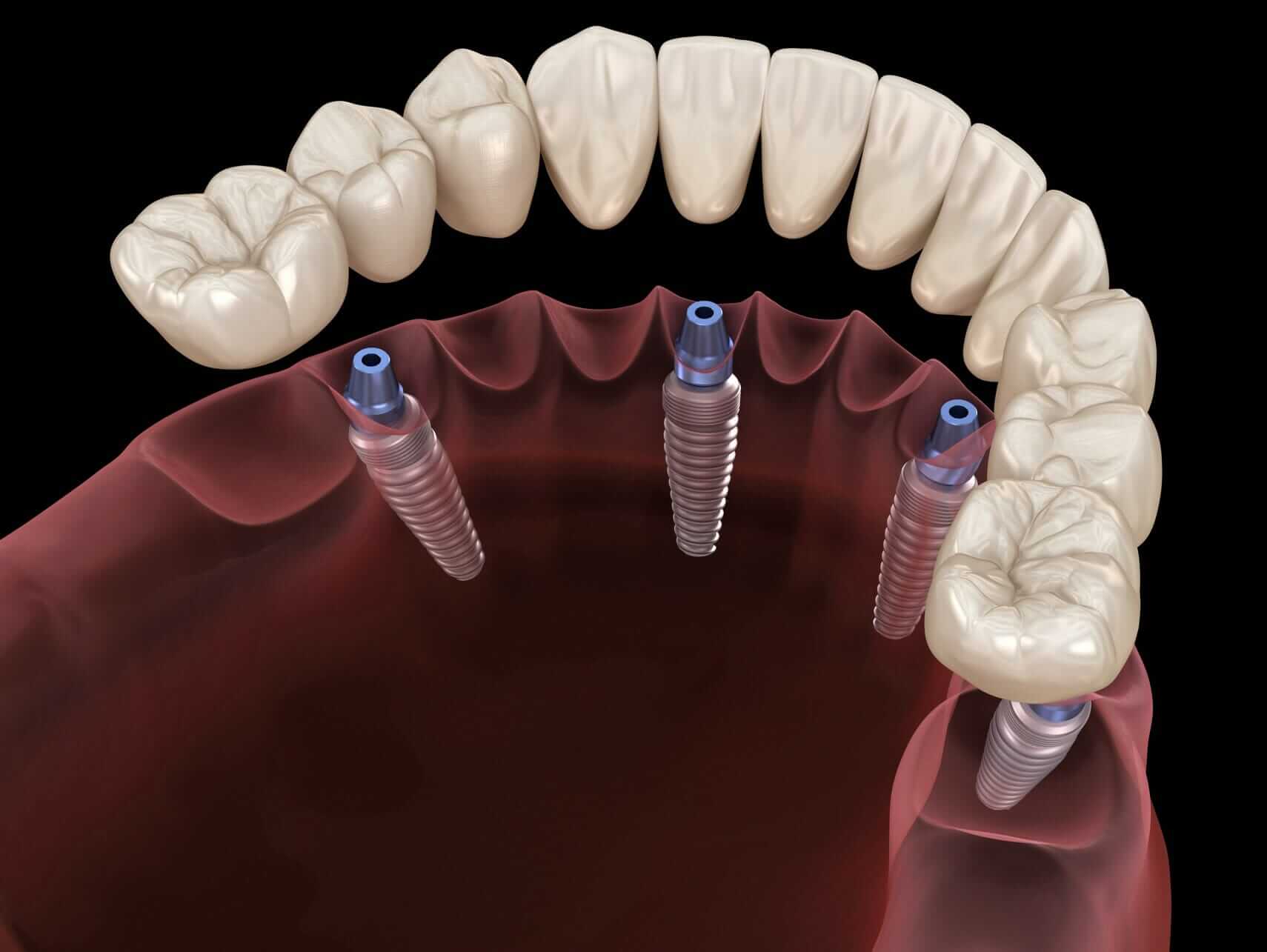 Lower Bridge with All on Four Dental Implants