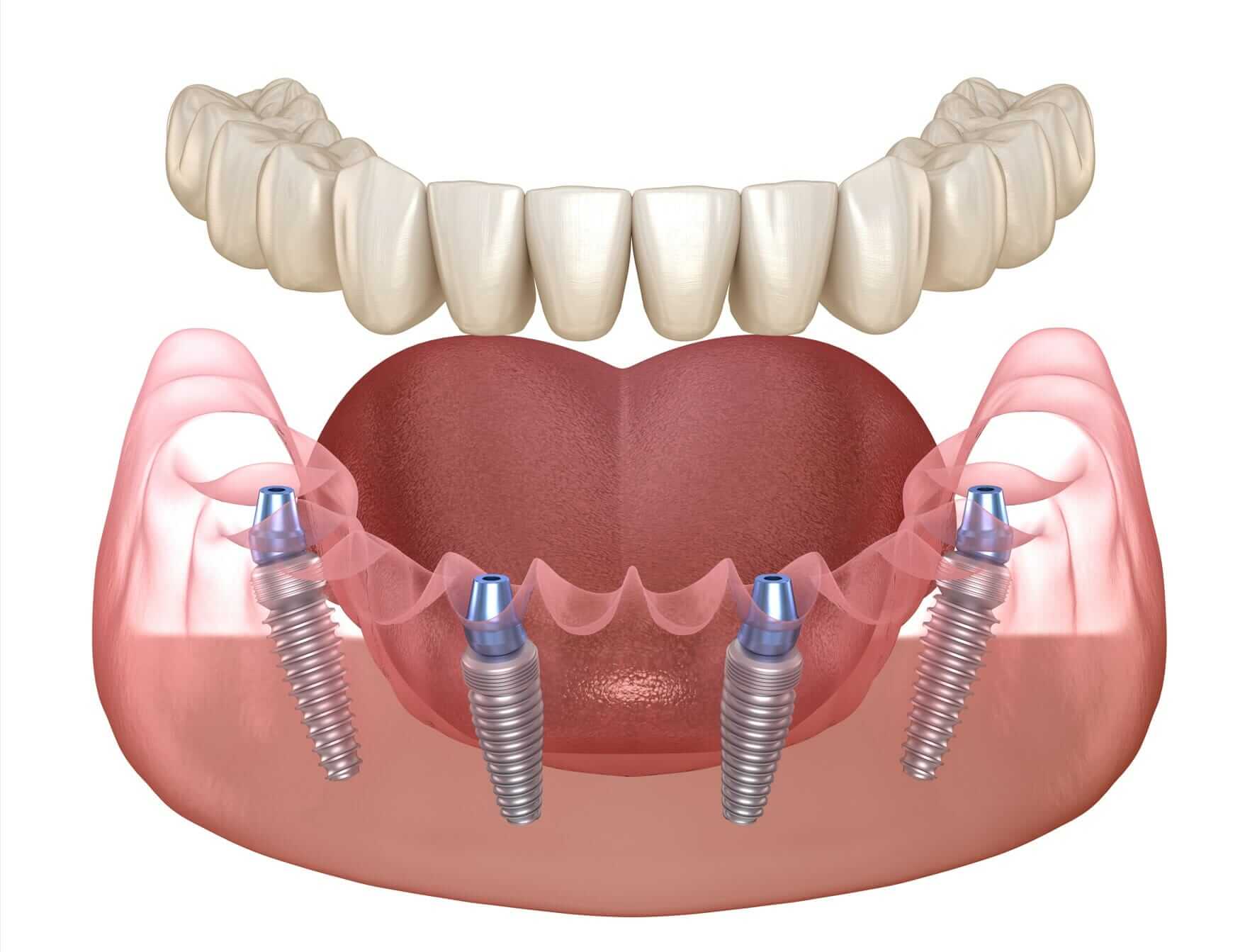 Lower All On 4 Dental Titanium Implants with Dental Bridge