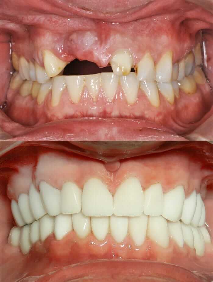Periodontal Disease - Stages of Periodontal Disease - Before and After