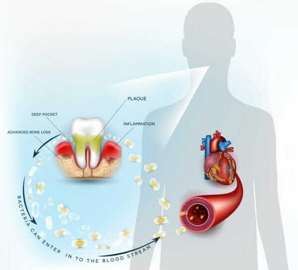 periodontitis and gum disease are linked to heart disease and strokes