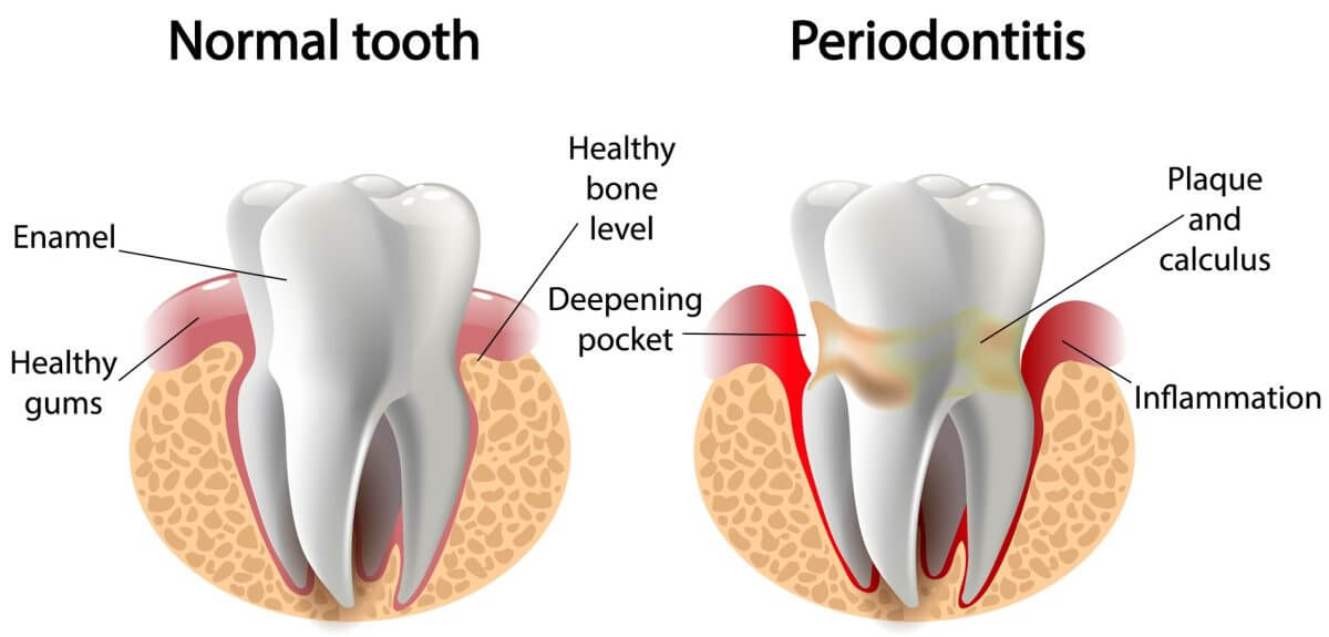 Periodontitis Tooth Inflammation from Tooth Decay