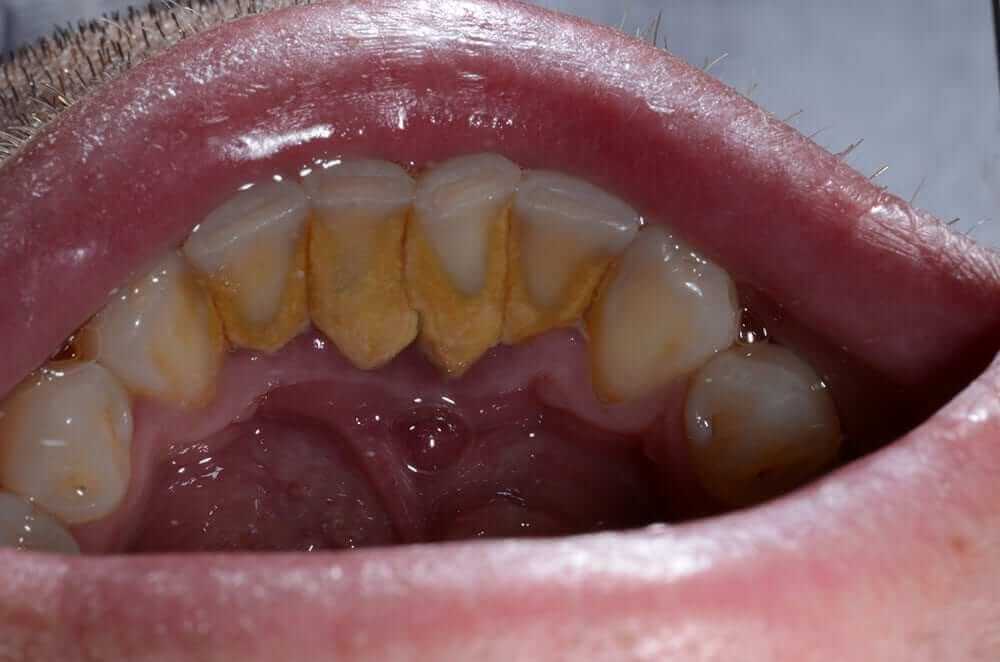 Poor Dental Hygiene Resulting in Severe Plaque Build Up and Gum Disease