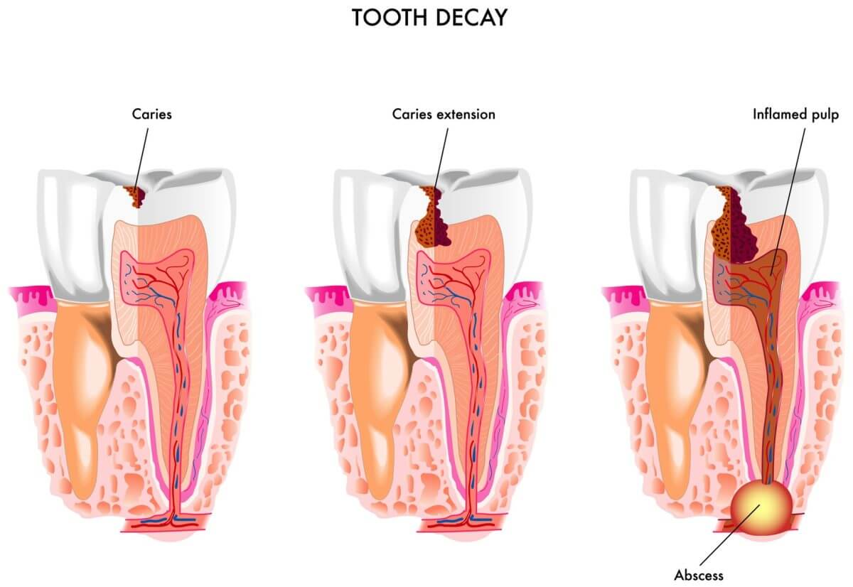 Pulpitis Inflammation and Tooth Abscess