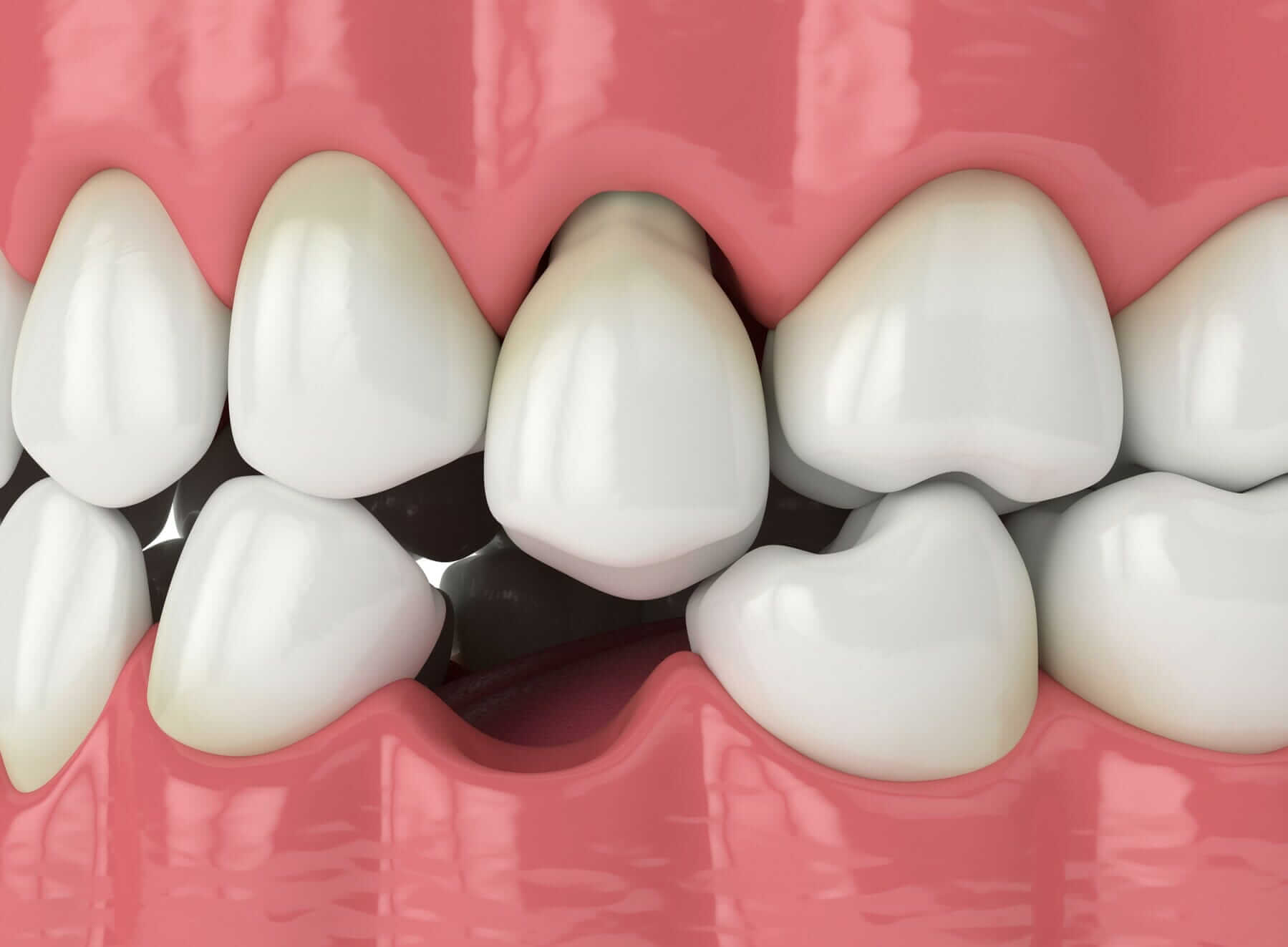 Shifting Teeth, Decreased Biting and Chewing Efficiency, Jawbone Loss, Adjacent Tooth Damage and Increased Risk of Gum Disease Can Occur When a Tooth is Extracted without a Replacement Dental Implant and Crown in That Position.